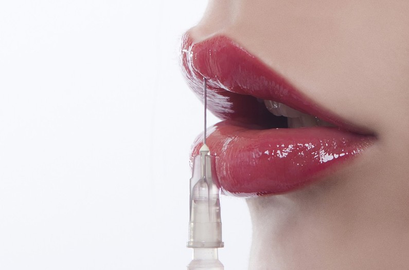 Wstrzykiwanie kwasu hialuronowego w usta kobiety