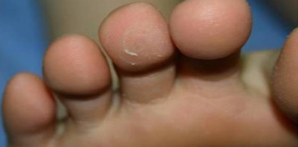 Brodawka wirusowa na palcu stopy po zabiegu