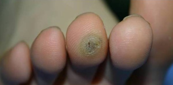 Brodawka wirusowa na palcu stopy przed zabiegiem