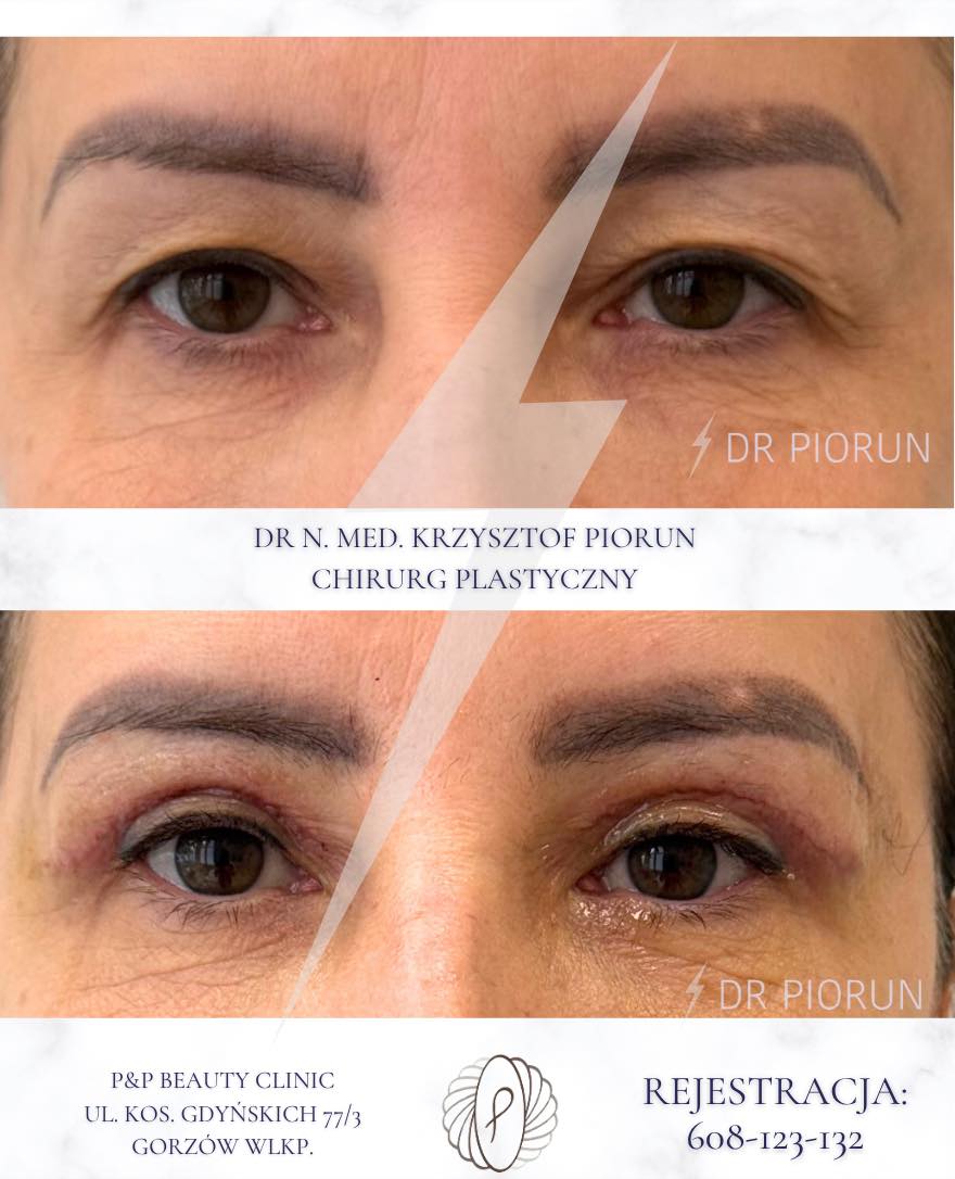 blefaroplastyka przed zabiegiem i siedem dni po