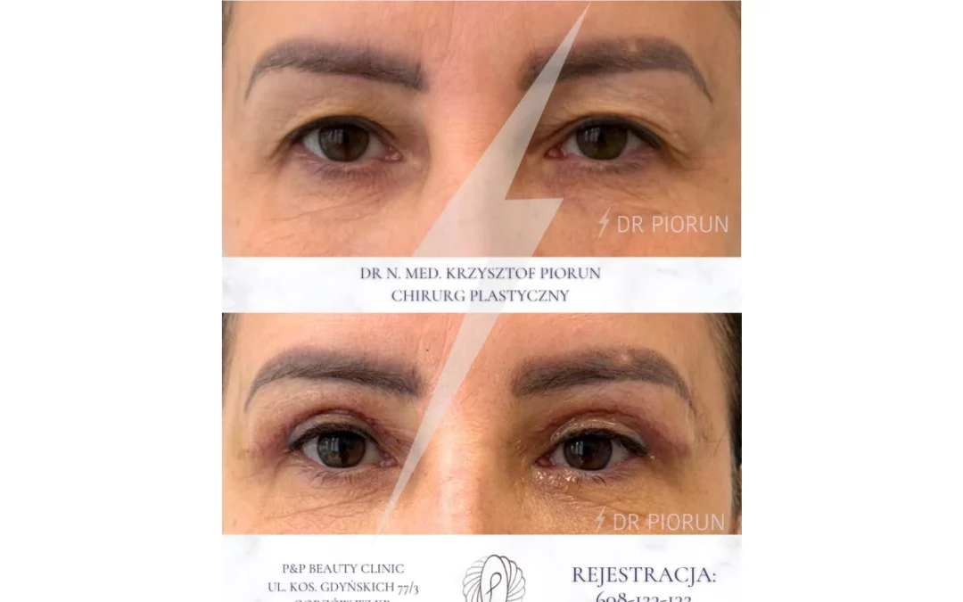 Blefaroplastyka