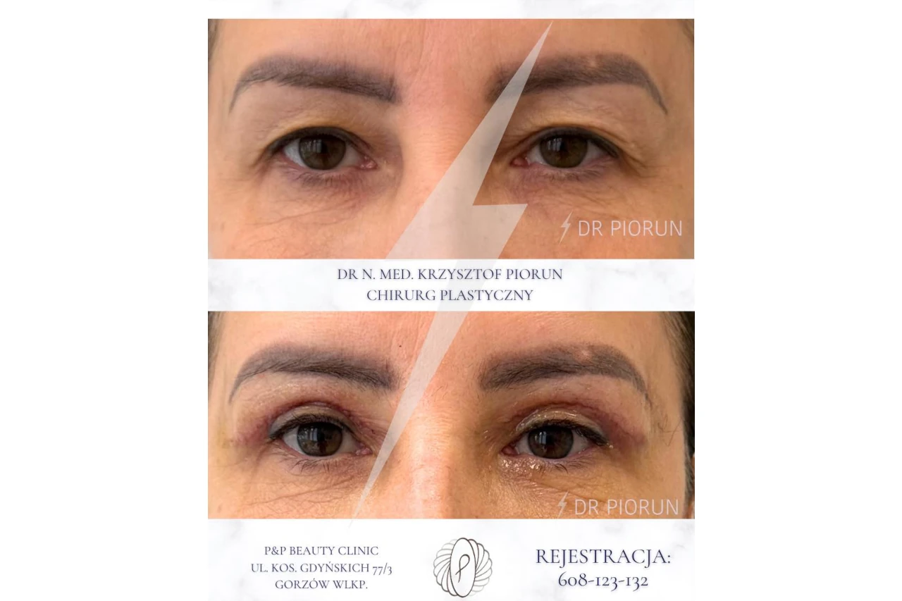 blefaroplastyka przed zabiegiem i siedem dni po