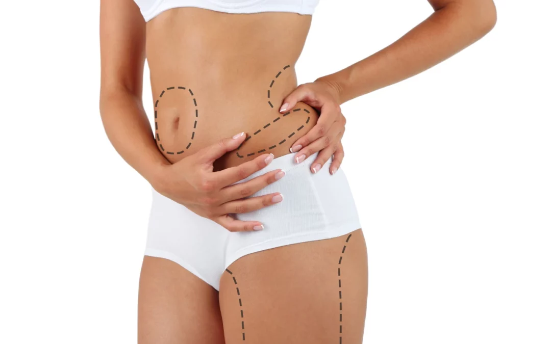 Liposukcja