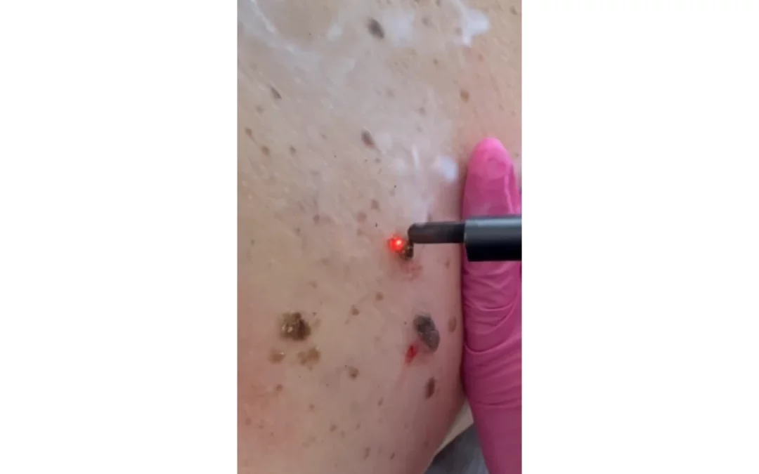 Laserowe usuwanie brodawek łojotokowych