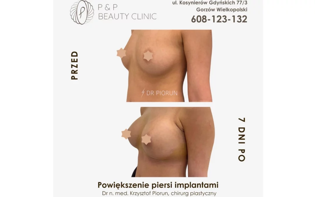 Powiększenie piersi przy użyciu implantów