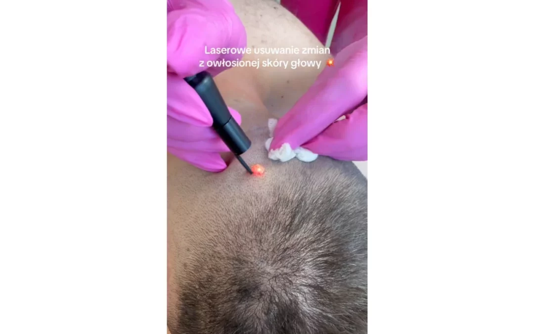 Laserowe usuwanie zmian z owłosionej skóry głowy