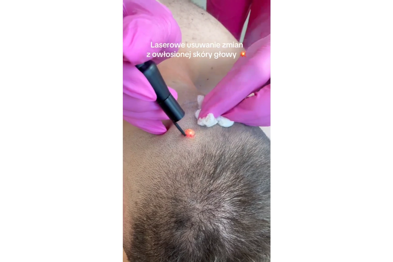usuwanie laserem brodawki z głowy