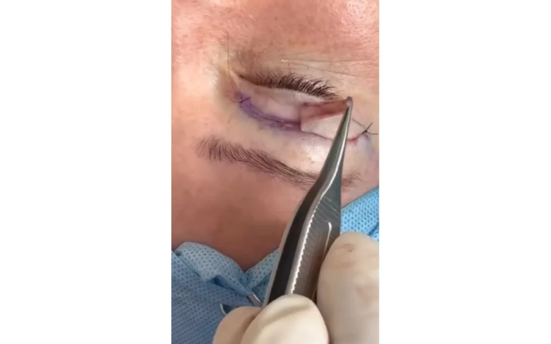 Plastyka powiek górnych