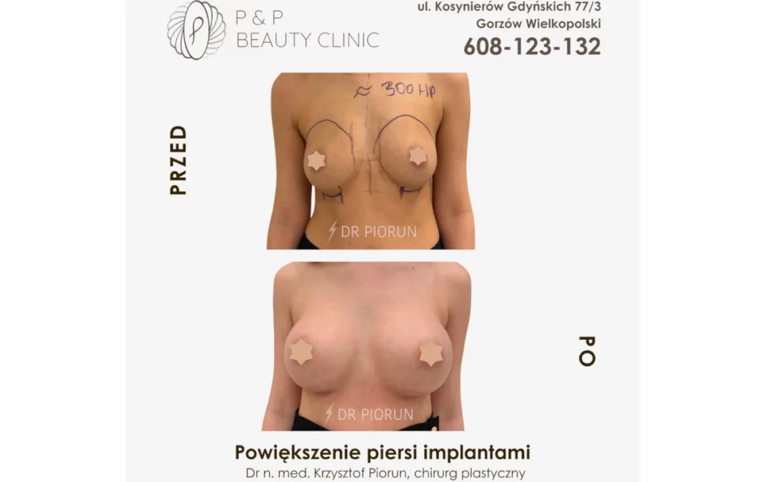 Powiększenie piersi implantami