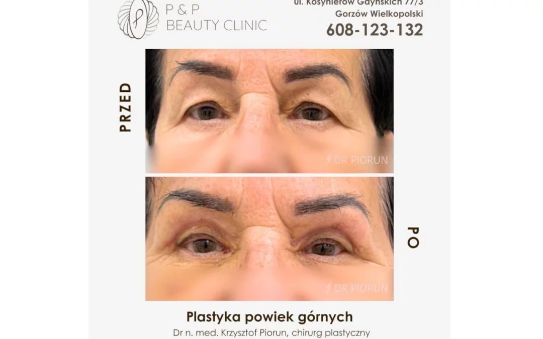 Plastyka powiek górnych