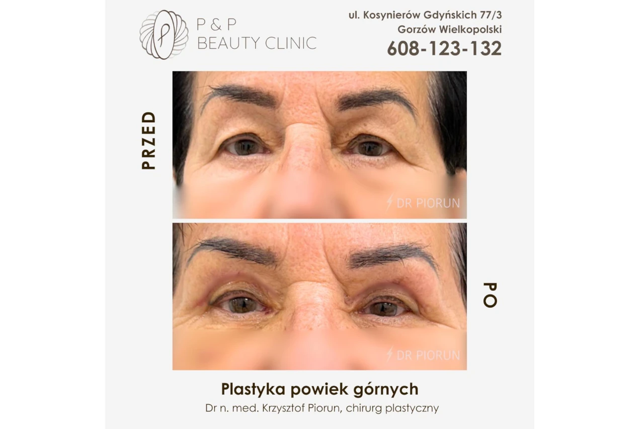 powieki kobiece przed i po zabiegu