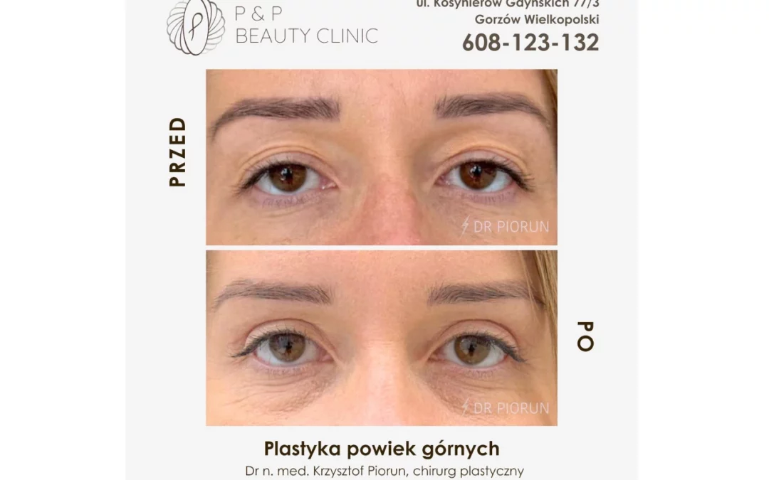 Blepharoplastyka