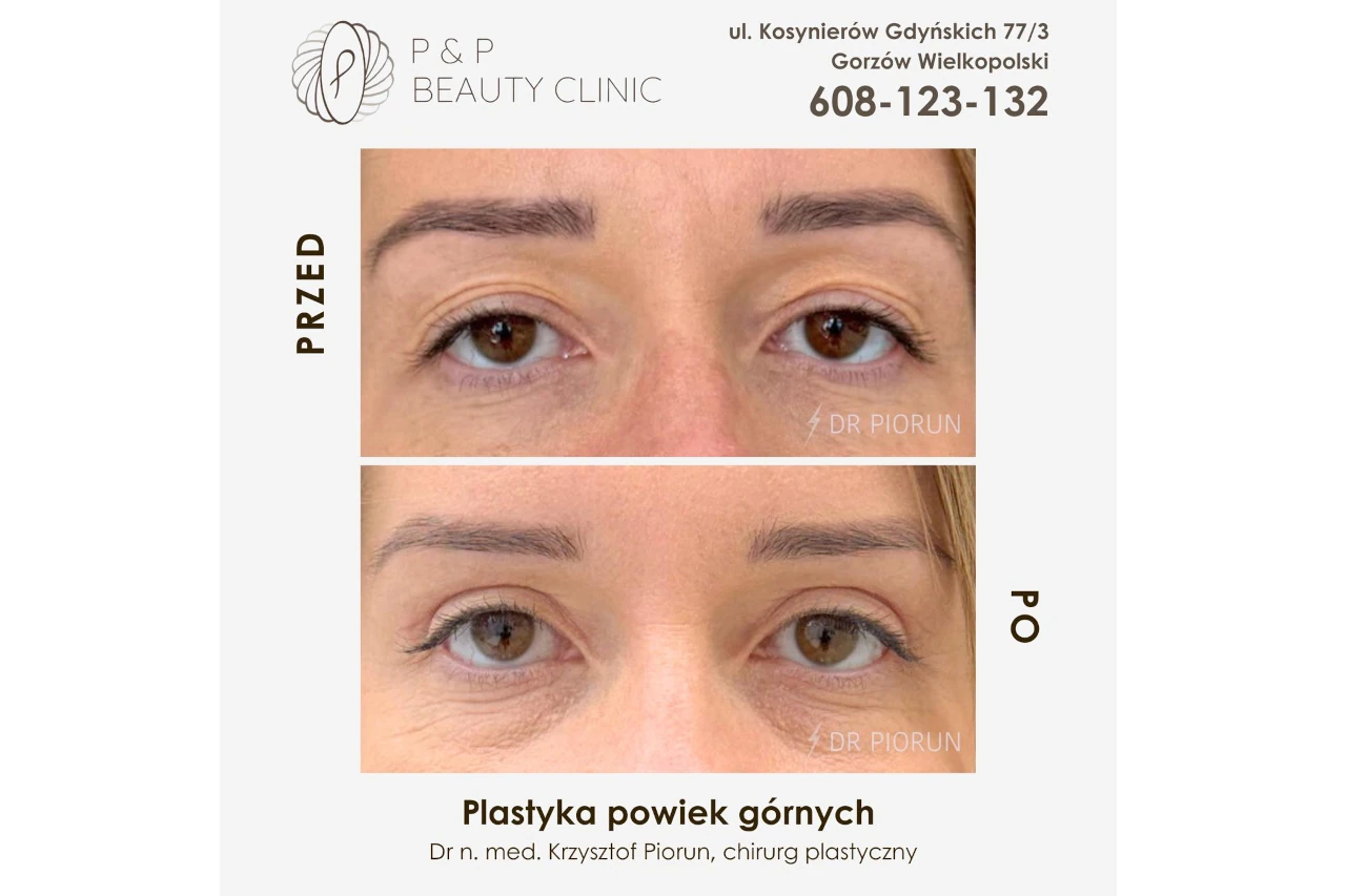 powieki kobiece przed i po zabiegu