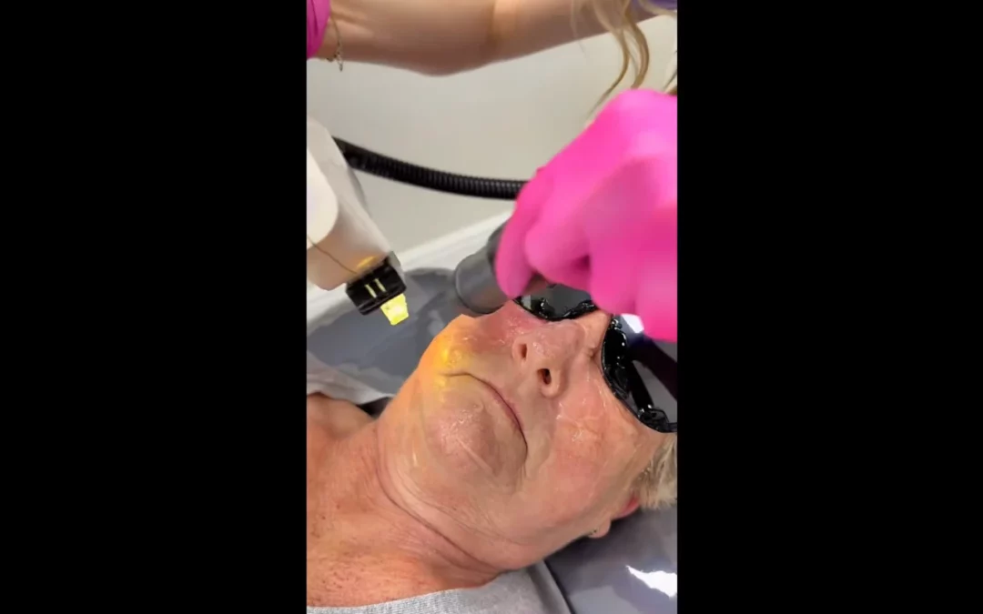 Zamykanie naczyń krwionośnych laserem