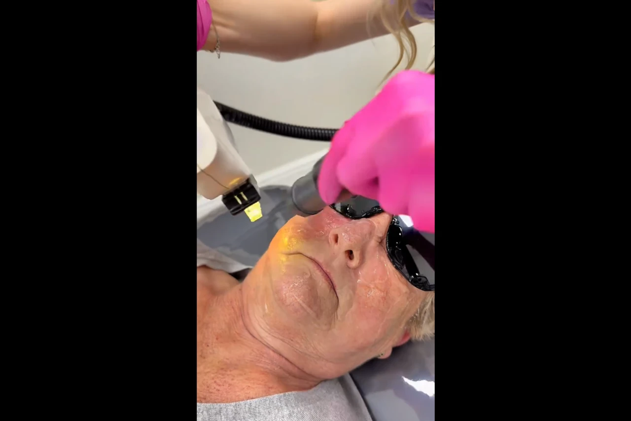 zamykanie naczyń krwionośnych na twarzy pacjenta laserem