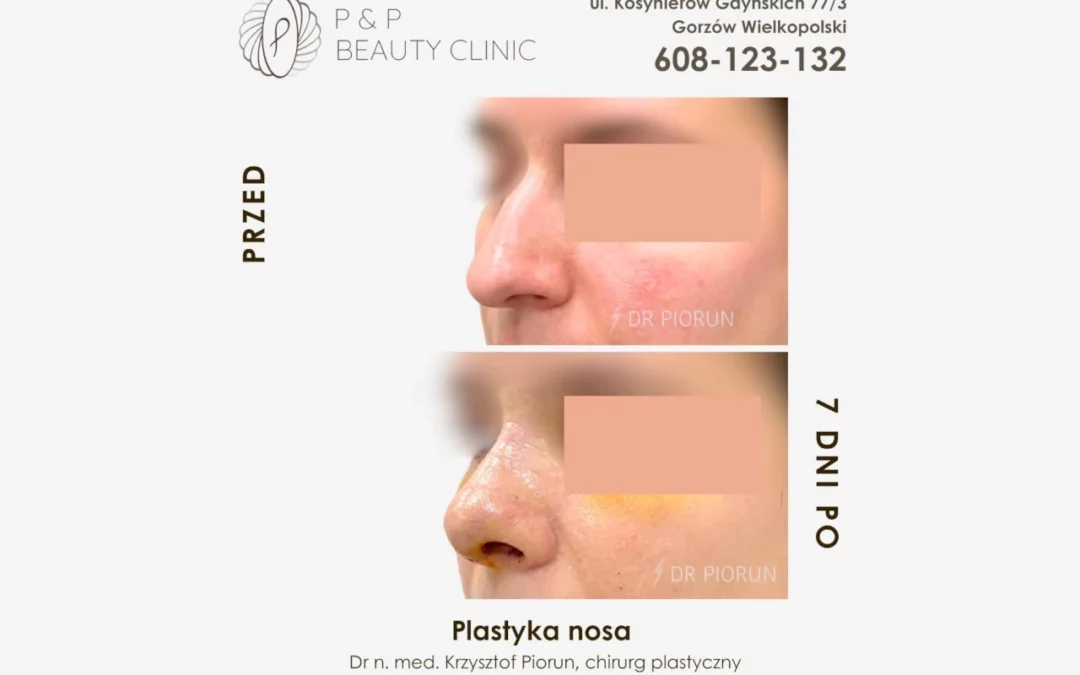 Operacja plastyczna nosa – przed i 7 dni po zabiegu