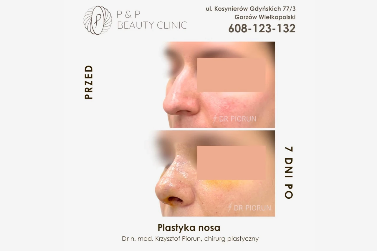 efekt korekcji nosa przed i siedem dni po zabiegu