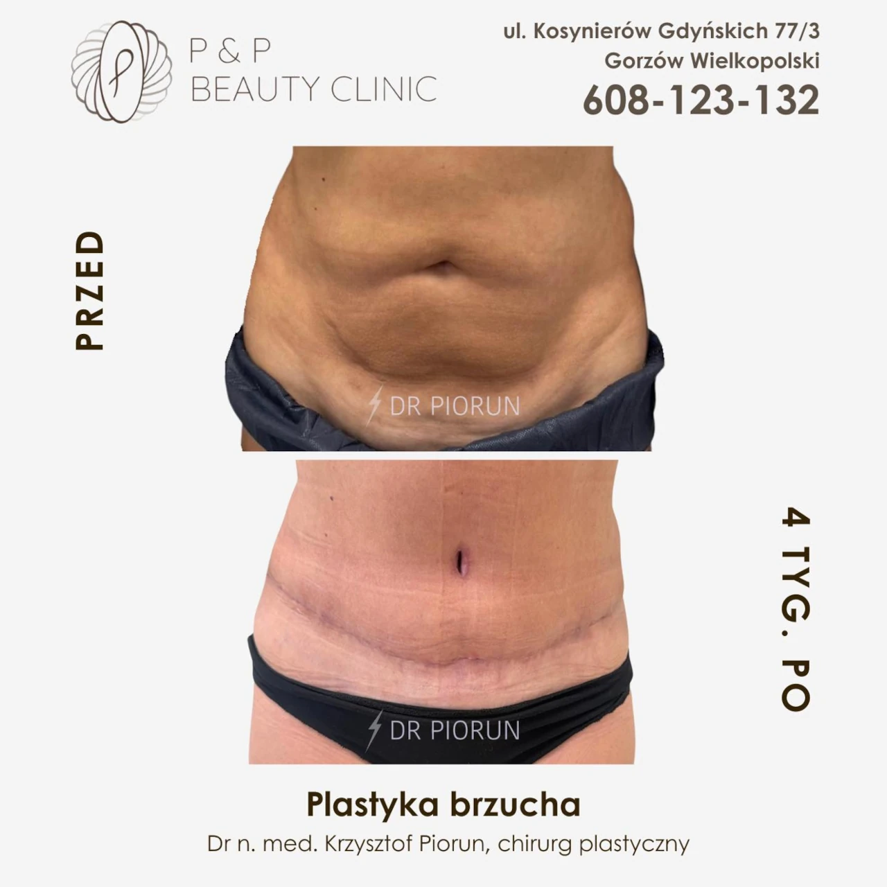 Abdominoplastyka brzuch przed plastyką i po