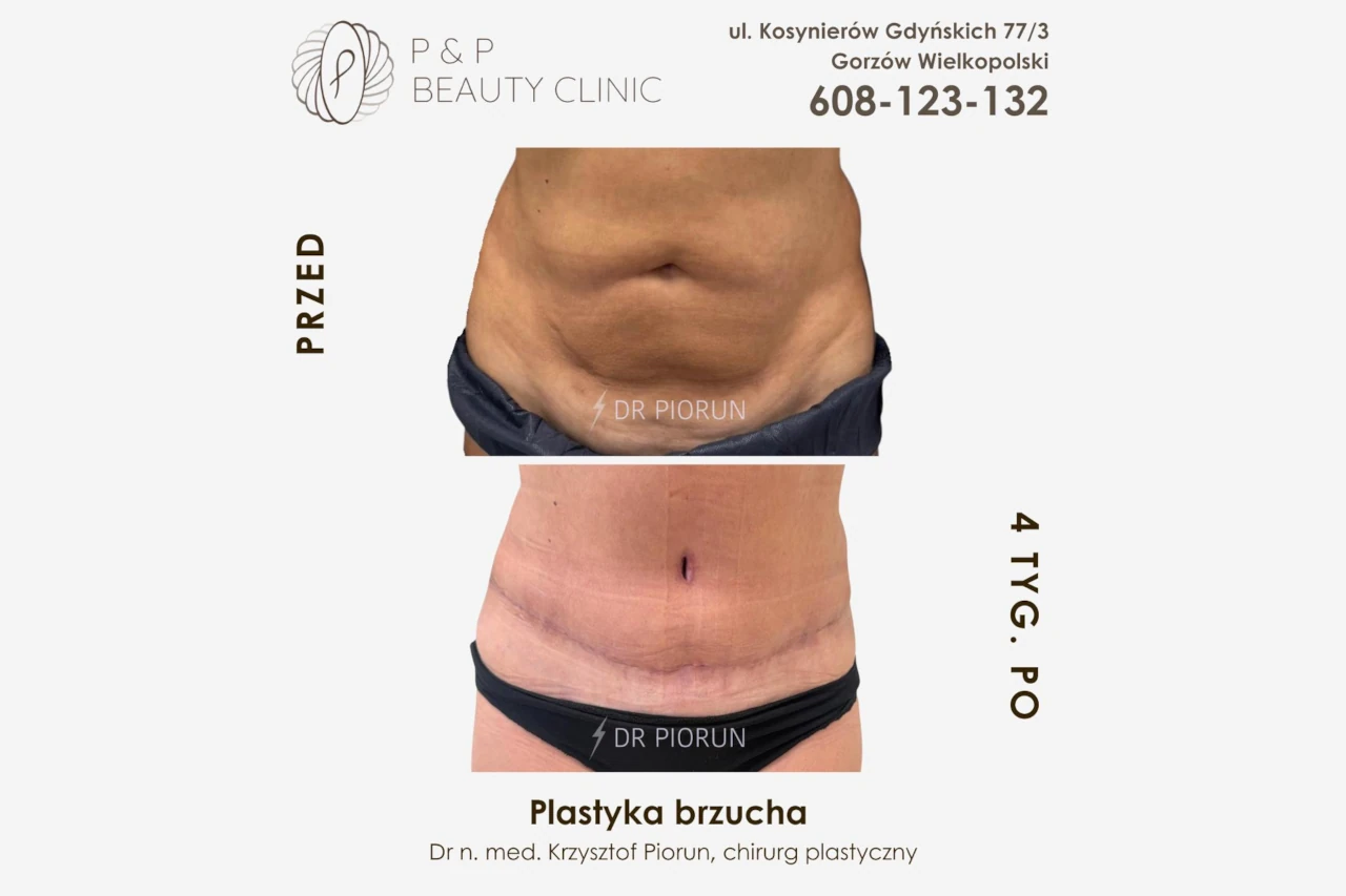 brzuch przed plastyką i po
