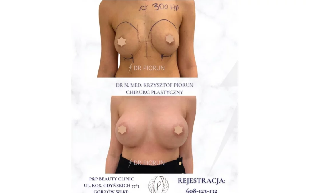 Powiększenie piersi – efekt operacji