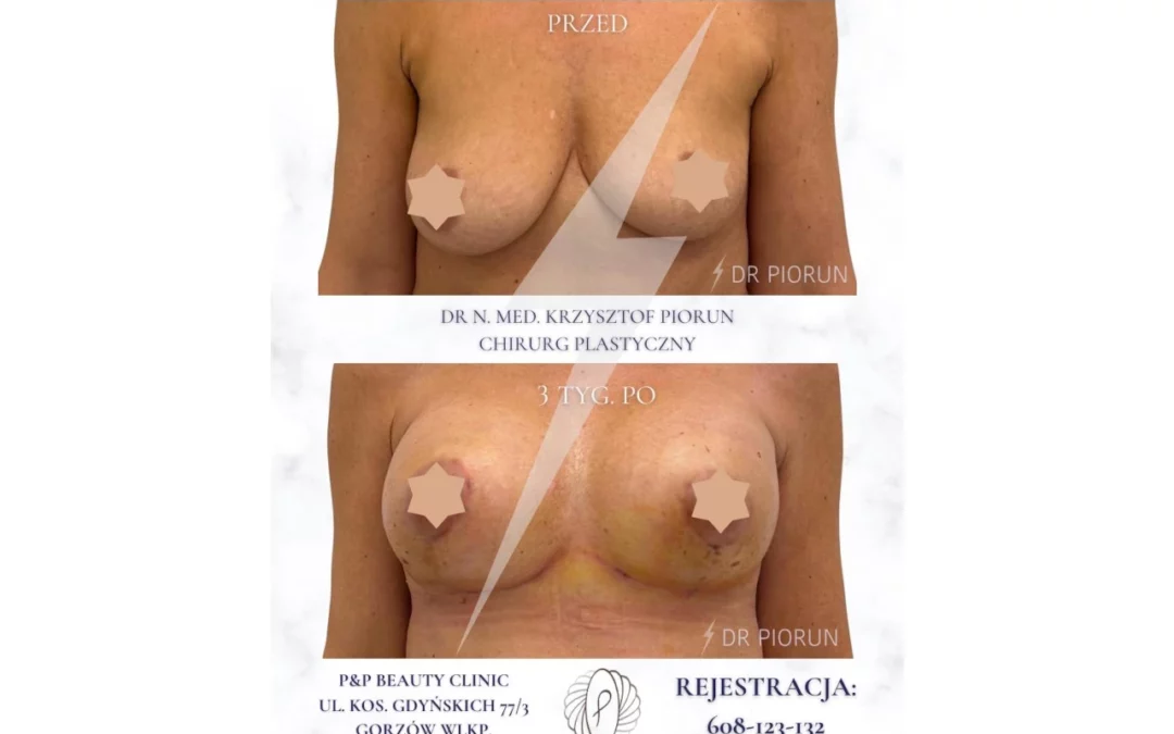 Mastopeksja – efekt zabiegu