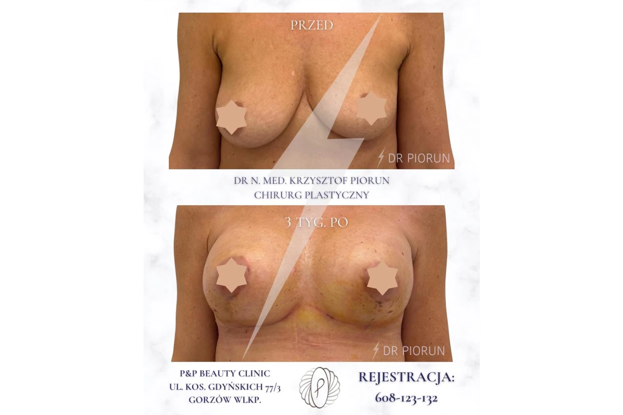piersi przed mastopeksja i po
