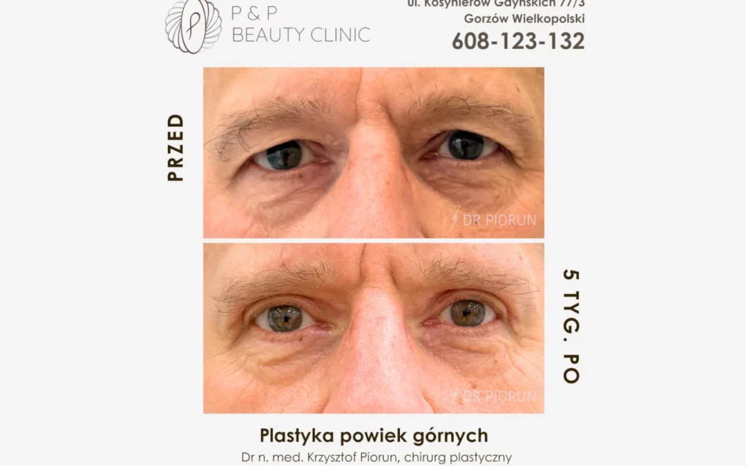 Plastyka powiek u mężczyzny
