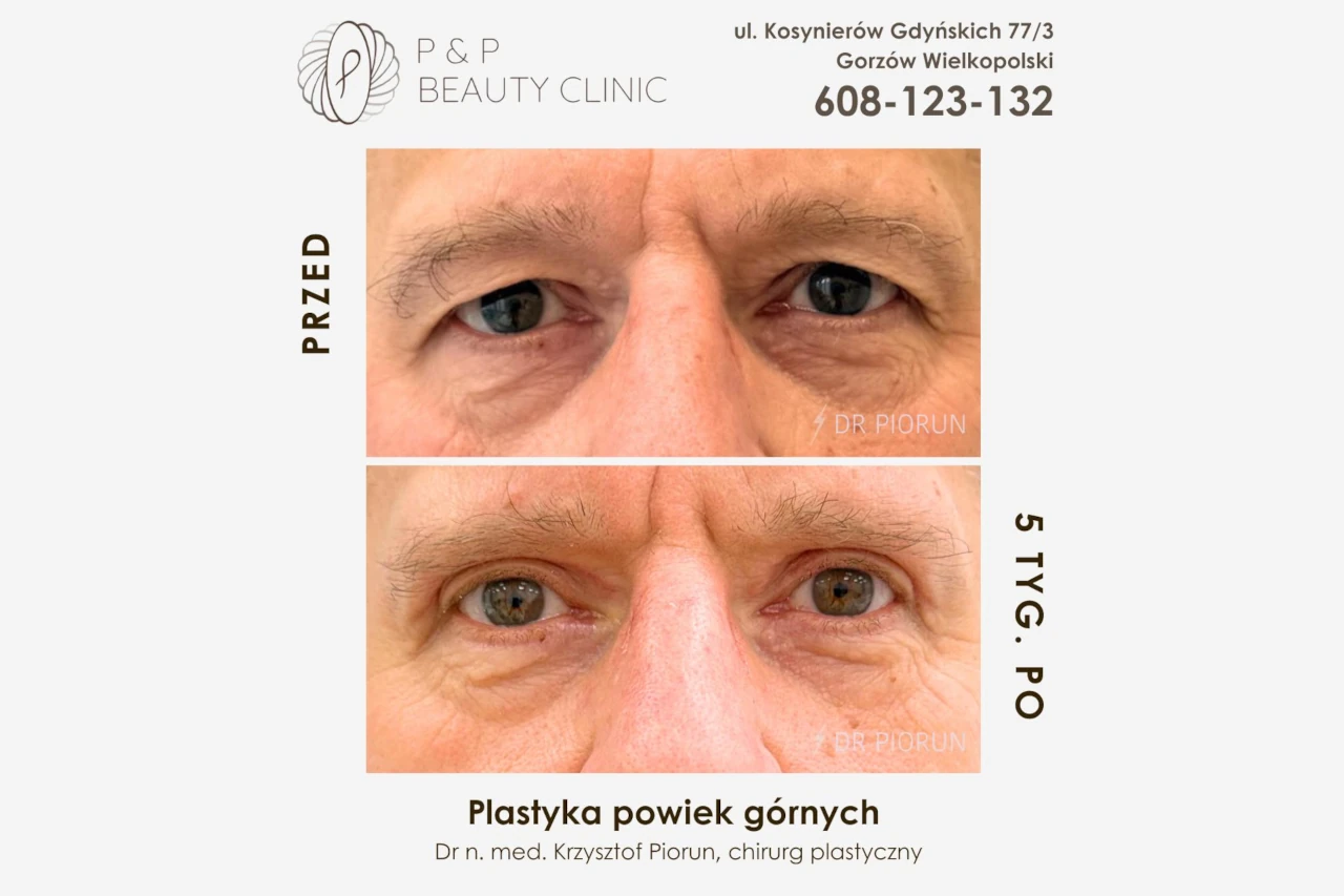 plastyka powiek mężczyzna