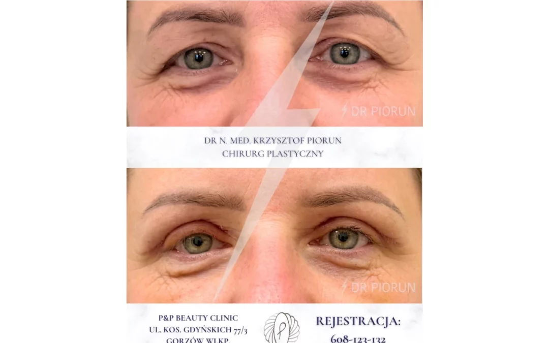 Plastyka powiek