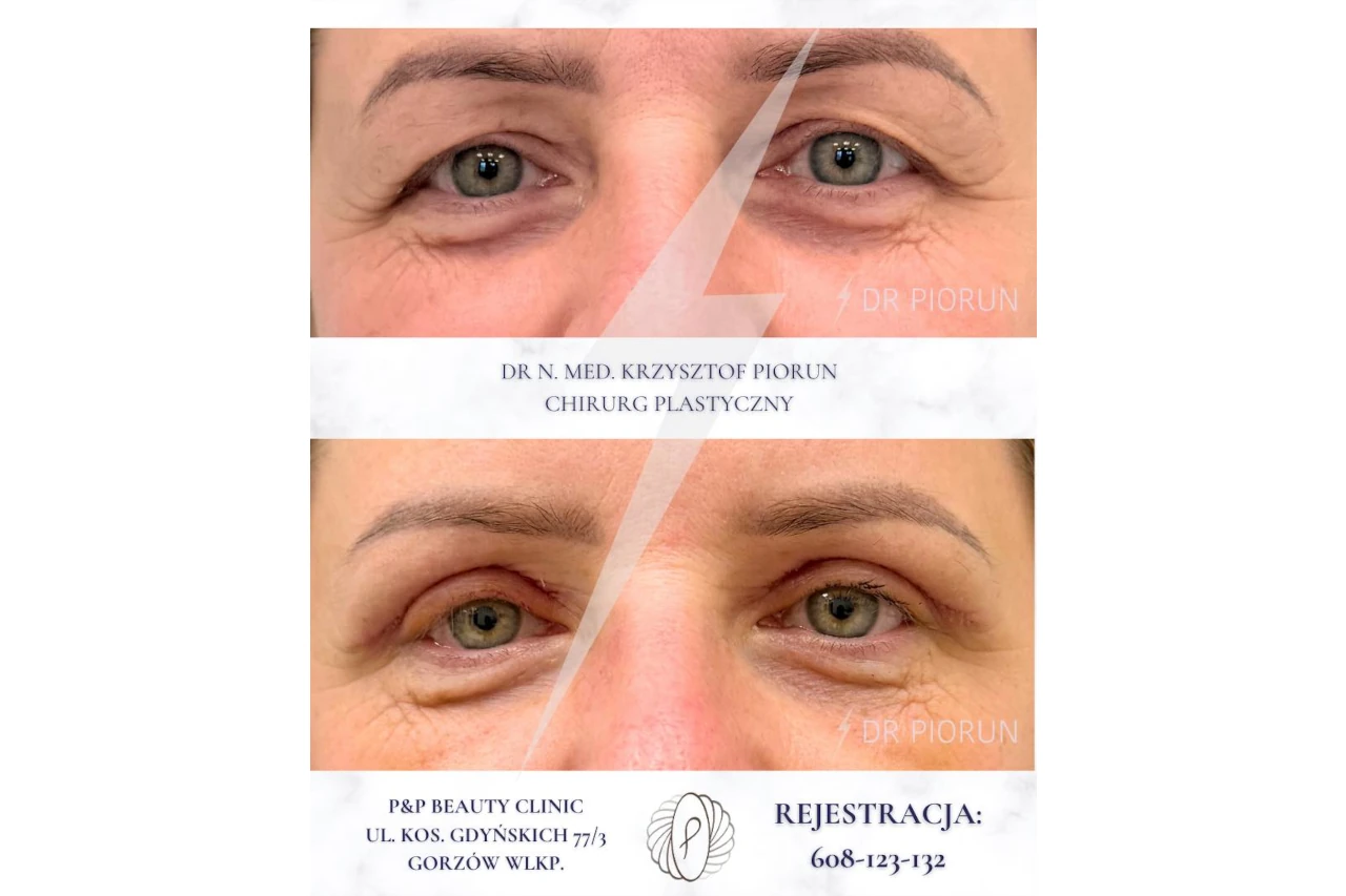 powieki kobiece przed i po zabiegu