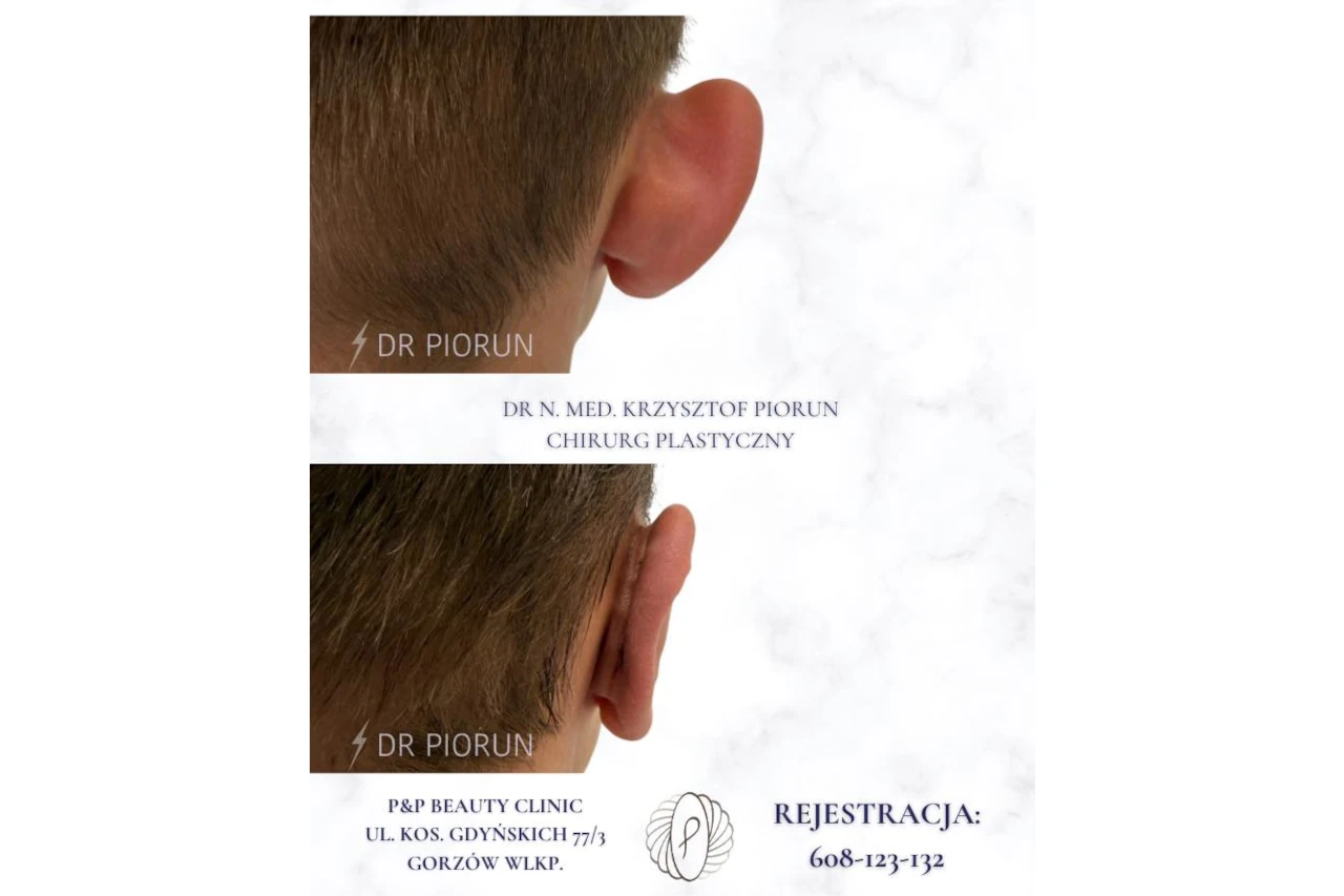 ucho przed i po otoplastyce