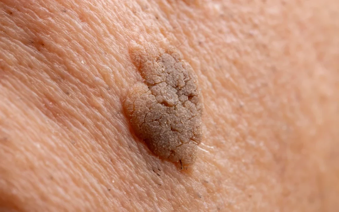 Usuwanie brodawek łojotokowych